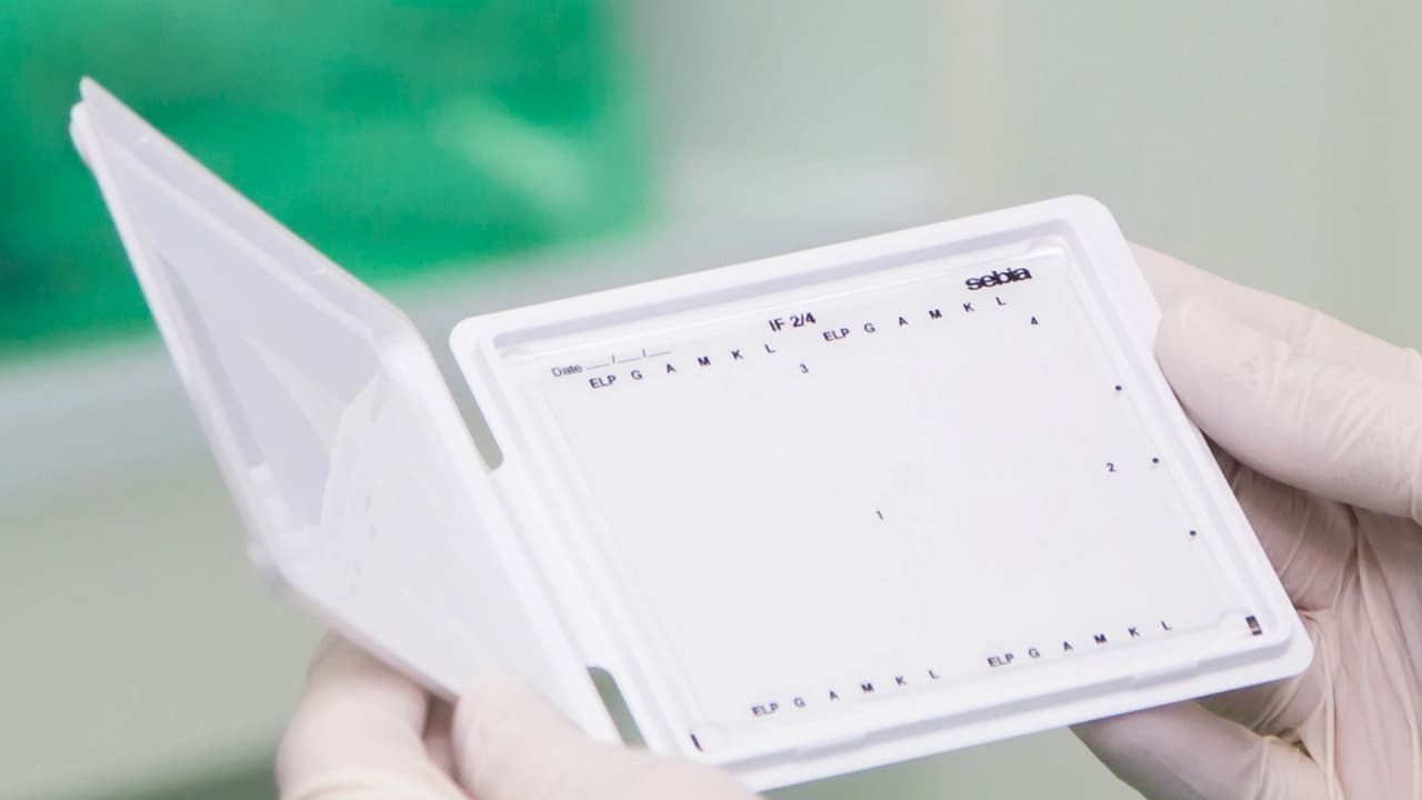 Hands holding a Sebia Gel used on the HYDRASYS 2 Scan Focusing instrument